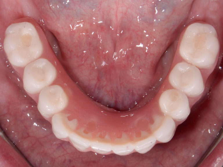 55yo-Caucasian-Male-After-3