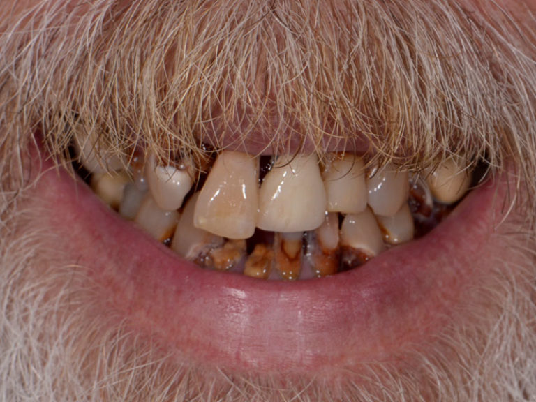 55yo-Caucasian-Male-Before-1