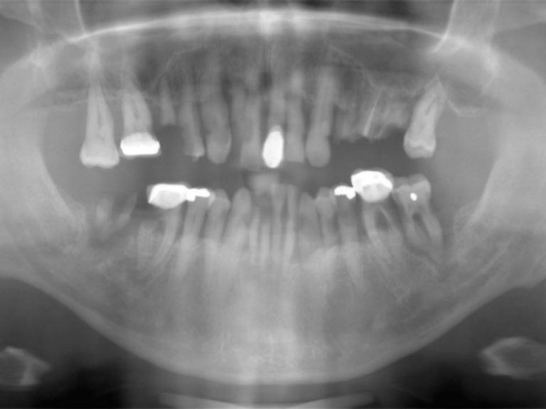 55yo-Caucasian-Male-Before-2