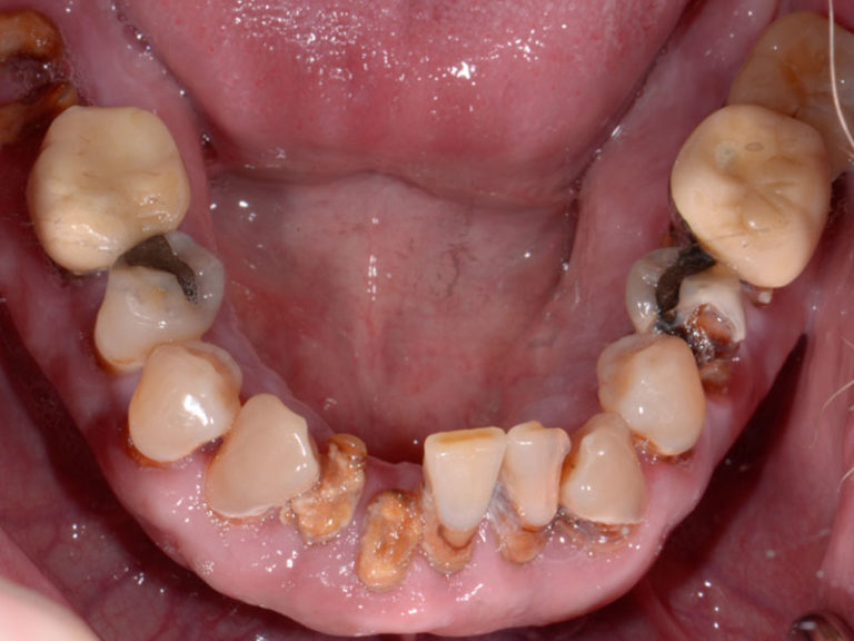 55yo-Caucasian-Male-Before-3