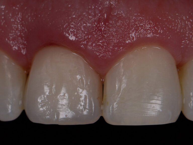 Clark-Case-Study-Implants-Post001