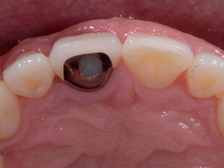 Clark-Case-Study-Implants-Post2