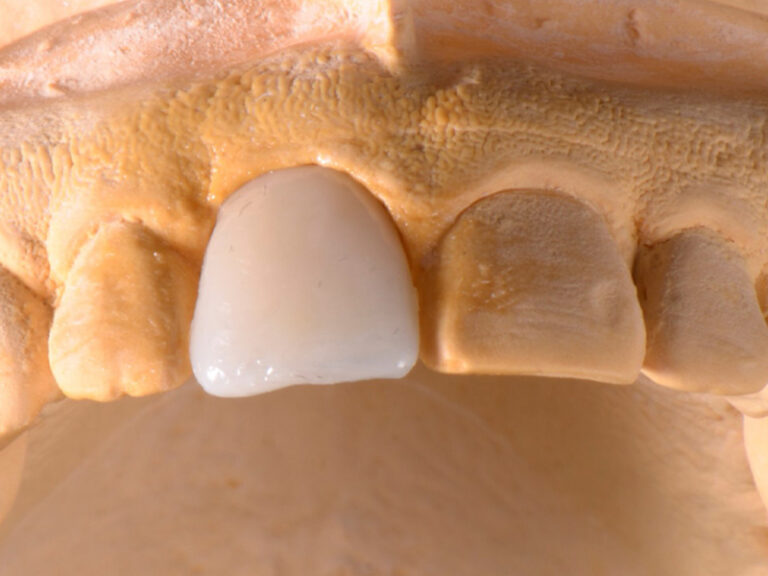 Clark-Case-Study-Implants-Post3