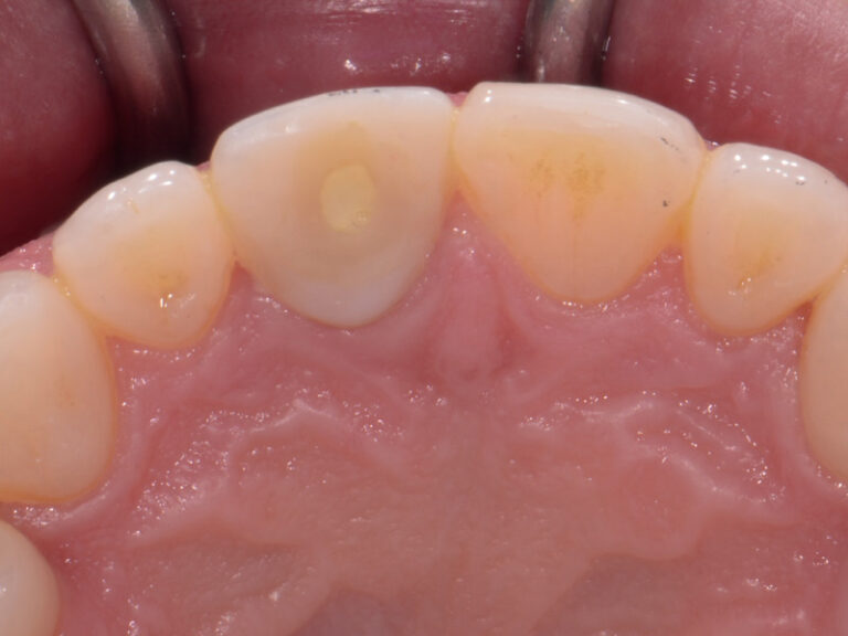 Clark-Case-Study-Implants-Pre2