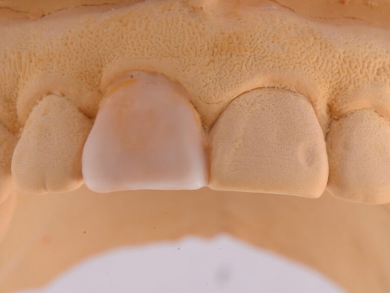 Clark-Case-Study-Implants-Pre3