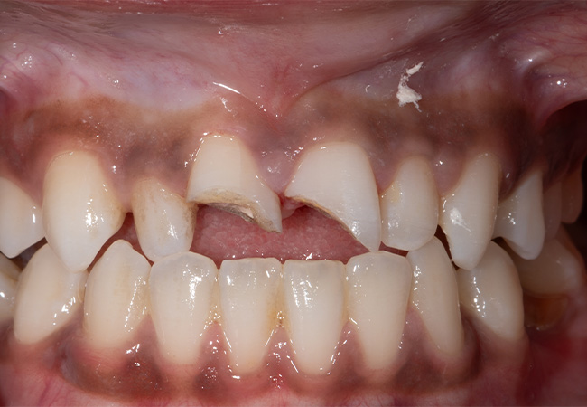 Clark-Cosmeticv Bonding5