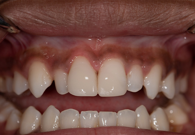 Clark-Cosmeticv Bonding6